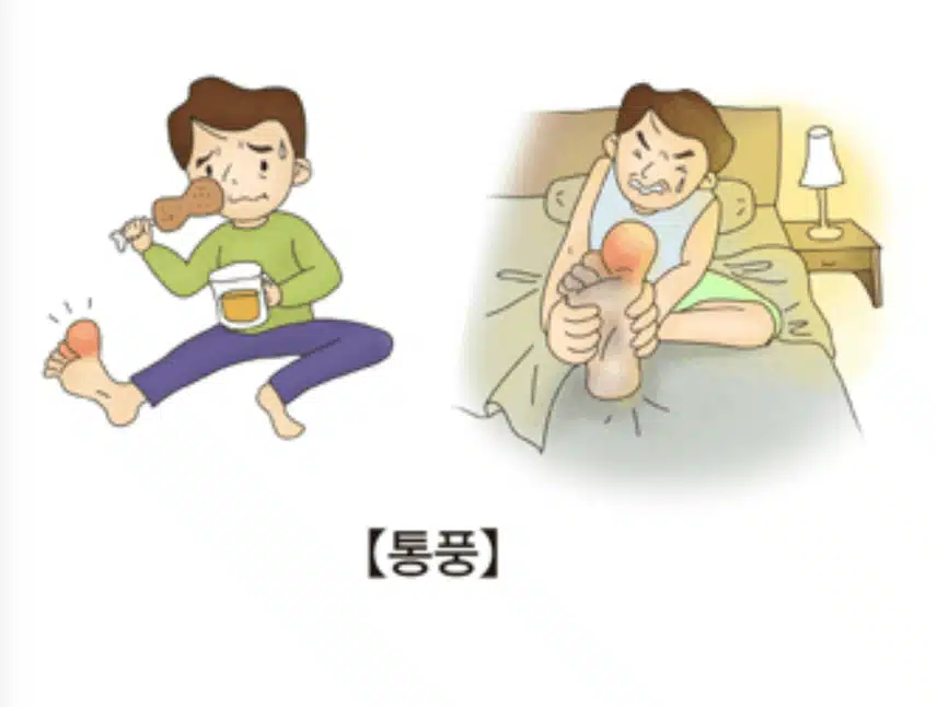 통풍 치료 민간요법 정말로 효과 있을까? (팩트체크)