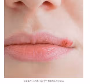 입술 포진 헤르페스에 대해 알아보자, 