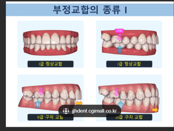 치아교정 발치 부작용 있나요? 교정 발치 무섭네요