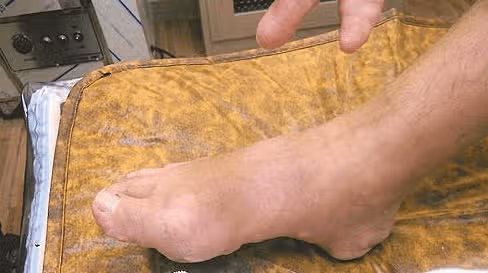 통풍 완치 불가능 하다고 하지만, 완화는 할 수 있습니다!
