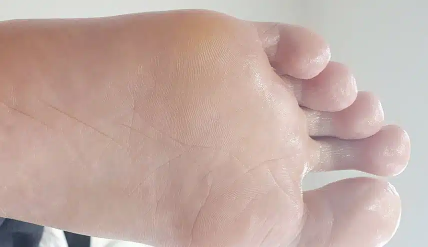 발바닥 바깥 테두리 통증, 족저근막염 아니겠죠?