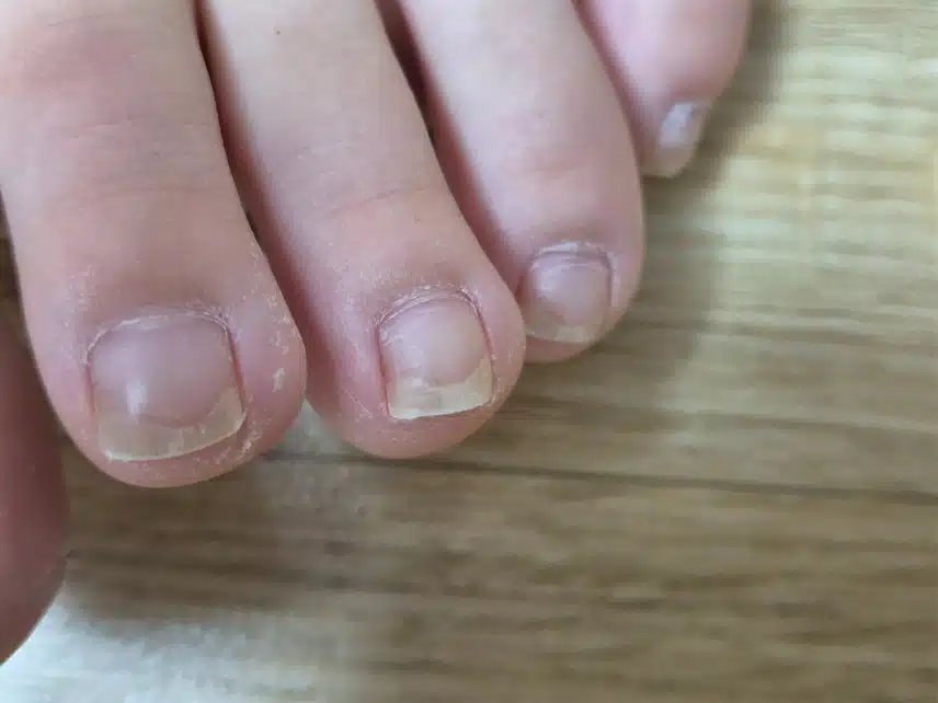 내성발톱 자가치료를 위해서는 기르는 수 밖에 없나요?