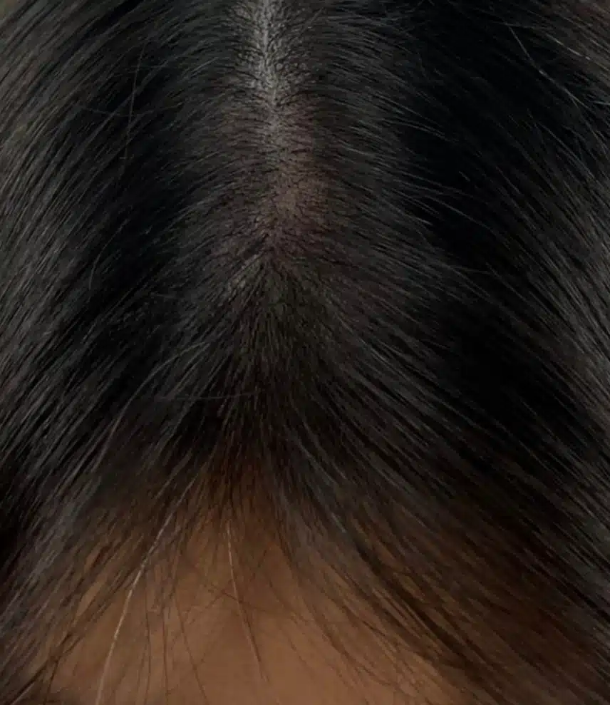 탈모 관리법 궁금해요 시술 방법이 어떻게 되나요?