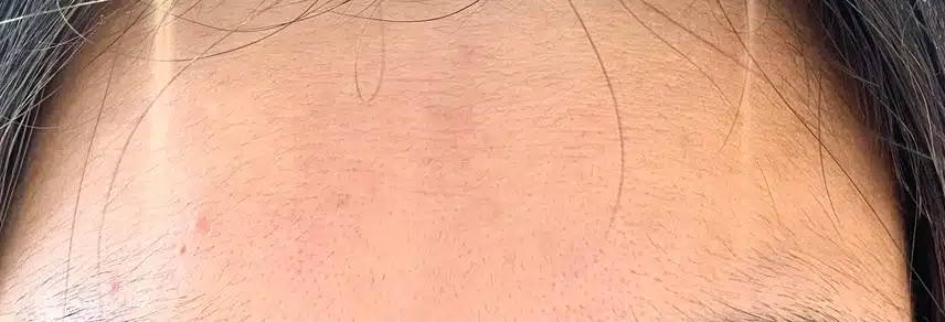 안검하수 수술 부작용 3가지 눈매교정 하지 마세요