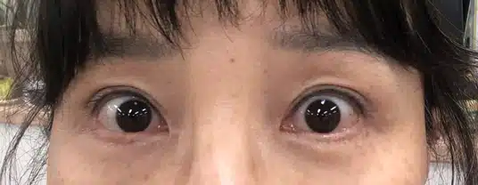 안검하수 수술 전후 : 상안검 수술 8개월차 후기