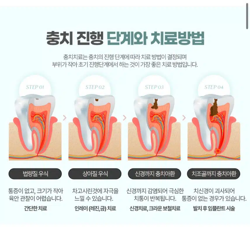 [추천왕] 리엔장치과 충치치료 후기