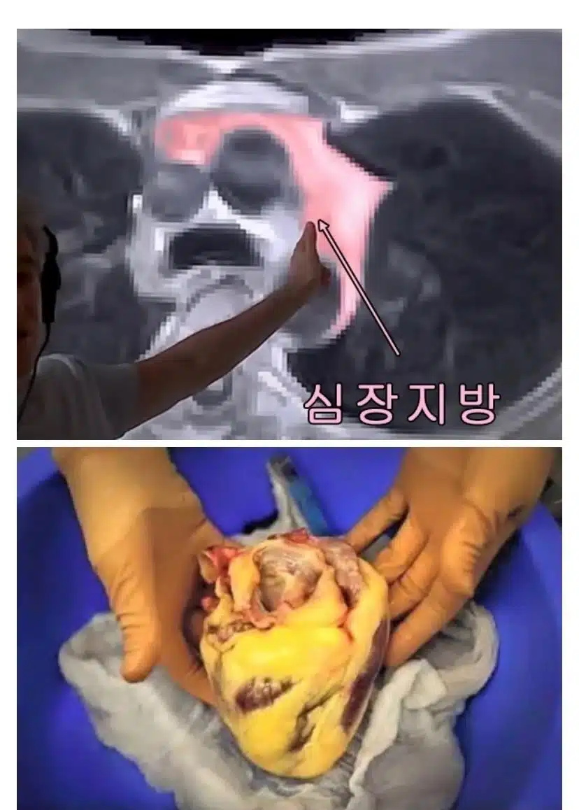 가공탄수화물을 먹으면 안되는 이유.