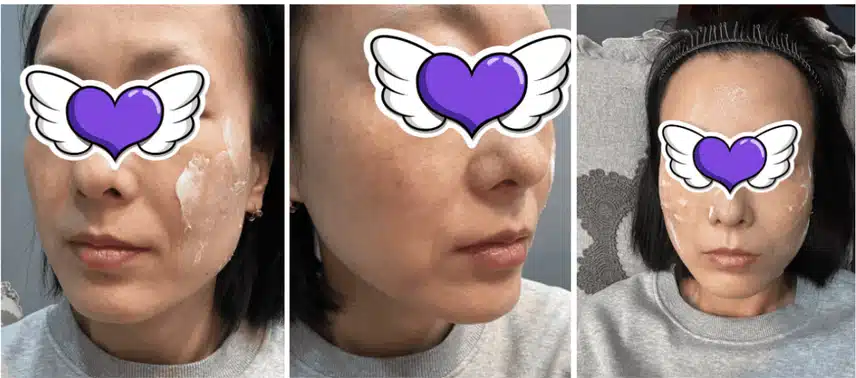 슈링크 시술 7가지 장점 및 3가지 유의사항 알려드려요~