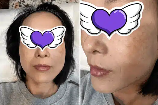 슈링크 시술 7가지 장점 및 3가지 유의사항 알려드려요~