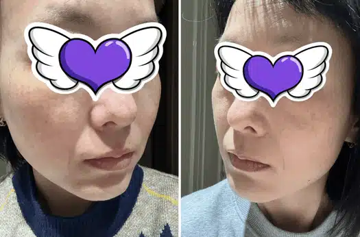 슈링크 시술 7가지 장점 및 3가지 유의사항 알려드려요~