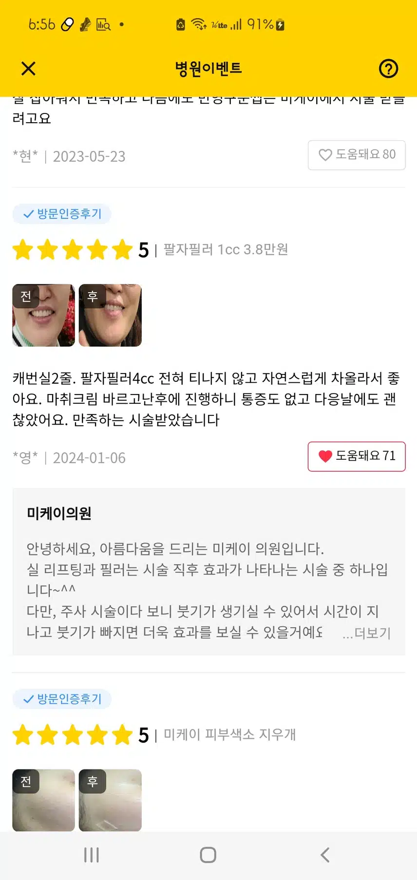 나이들어 근엄해지는 주름, 미케이의원 팔자필러로 펴봐요~