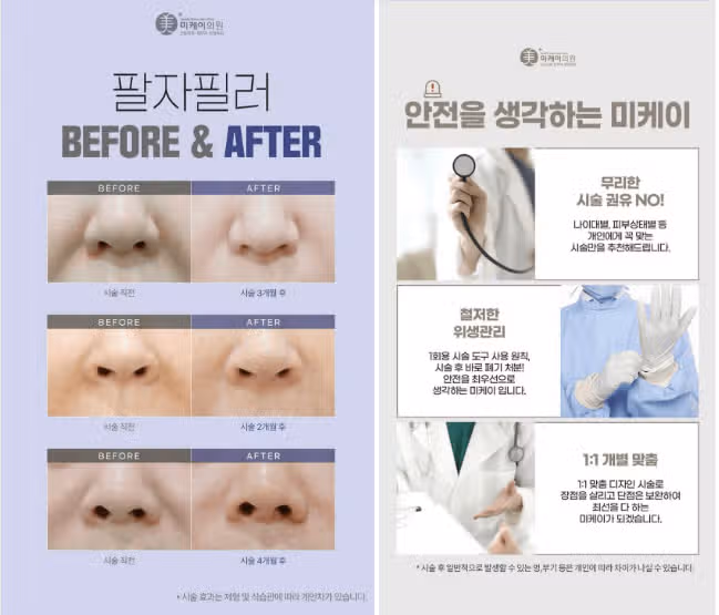 미케이의원 팔자필러 3.8만원 이벤트! 후기도 가격도 좋네요.