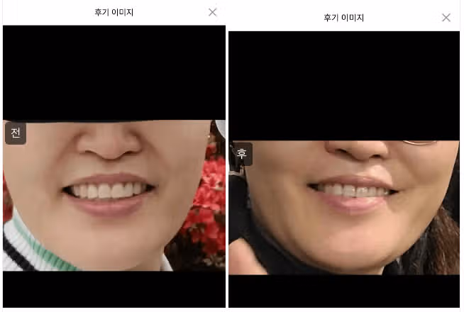 미케이의원 팔자필러 3.8만원 이벤트! 후기도 가격도 좋네요.