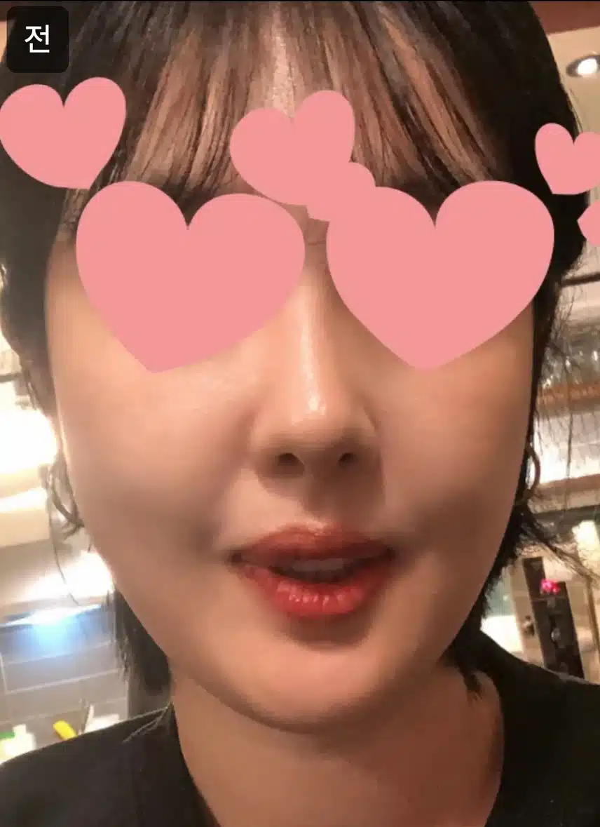 컴포트성형외과 편안한 수면 리쥬란 힐러 2cc 후기 추천해요!!