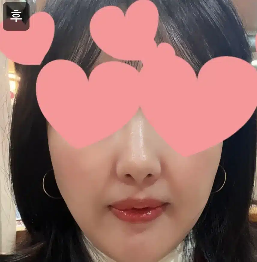 컴포트성형외과 편안한 수면 리쥬란 힐러 2cc 후기 추천해요!!