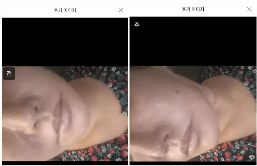 리버스클리닉 수원점 코어톡스&제오민 보톡스 이벤트와 후기 추천해요