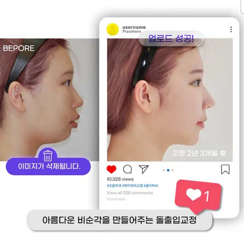 오른치과의원 뷰티라인 치아교정 후기를 추천하고 리뷰하고자 합니다! 