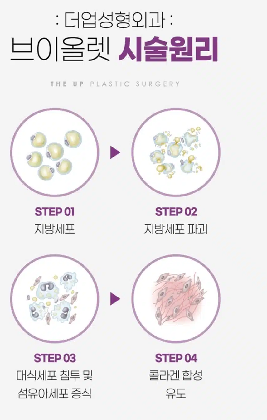  [추천]더업 성형 외과 의원의 브이업 성형시술 추천합니다