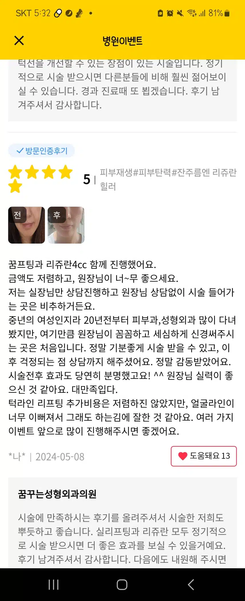 꿈꾸는 성형외과에서 얼굴 탄력업 시켜주는 실리프팅 후기 추천해요 