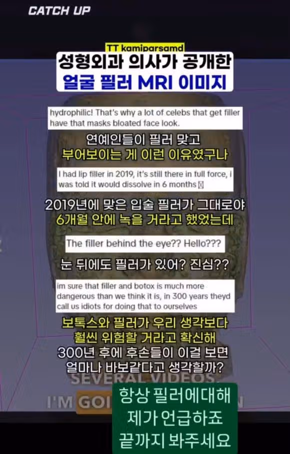 필러맞고 얼굴 커지는 이유