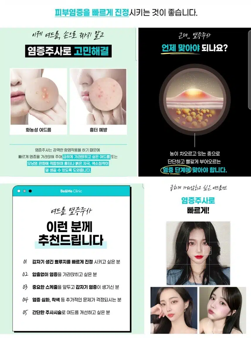 압구정비앤미 여드름염증주사 후기와 이벤트 추천합니다