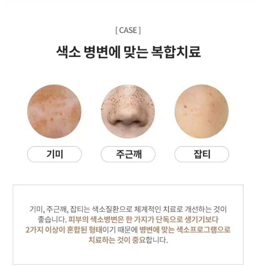  [추천]유앤아이 영등포점  색소치료 추천합니다