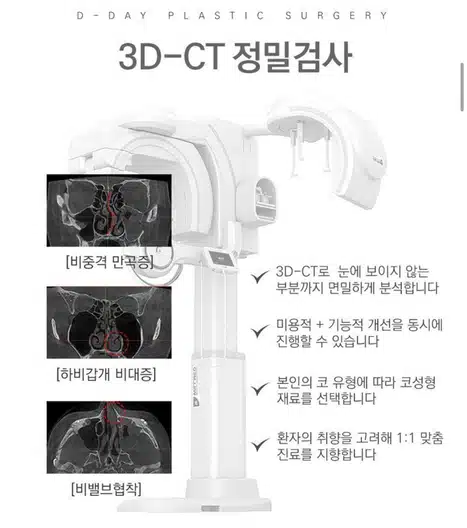서울 강남구 디데이성형외과의원 콧볼축소 후기 추천할게요!