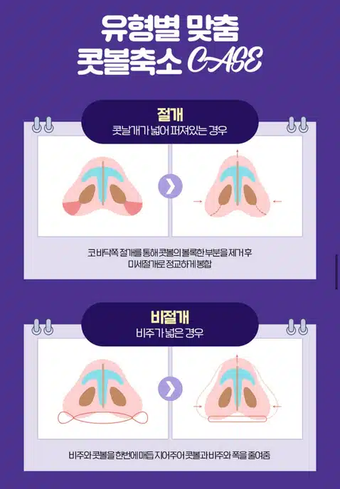 서울 강남구 디데이성형외과의원 콧볼축소 후기 추천할게요!