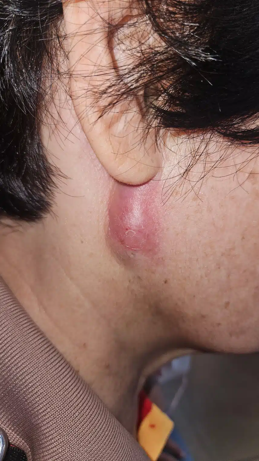 10년 넘은 피부낭종 치료후기.