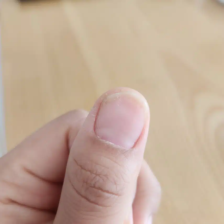 손톱모양이 이상.. 손톱무좀초기인가 싶어요