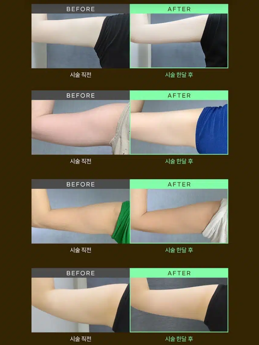 서초구 미케이의원 팔뚝빼기 1회 9,5만원(부가세별도)  후기 
