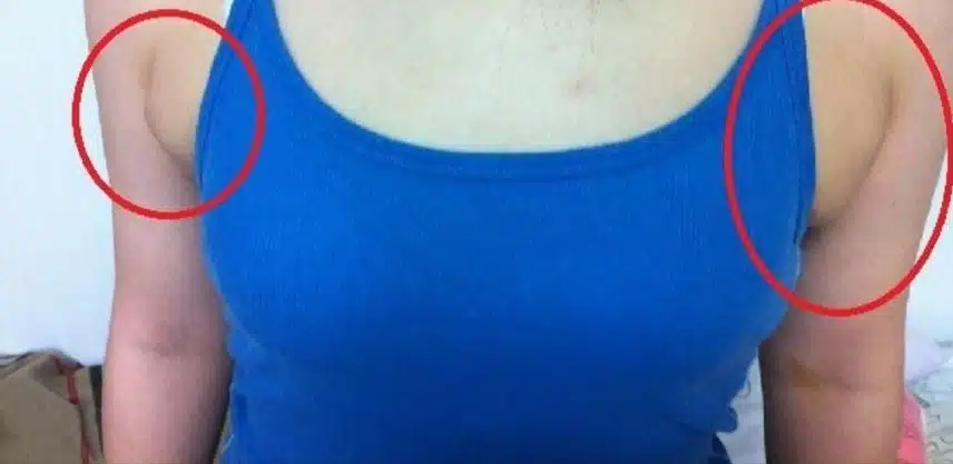(질문)보기 싫은 부유방 때문에 고민되요 수술해야 할까요?