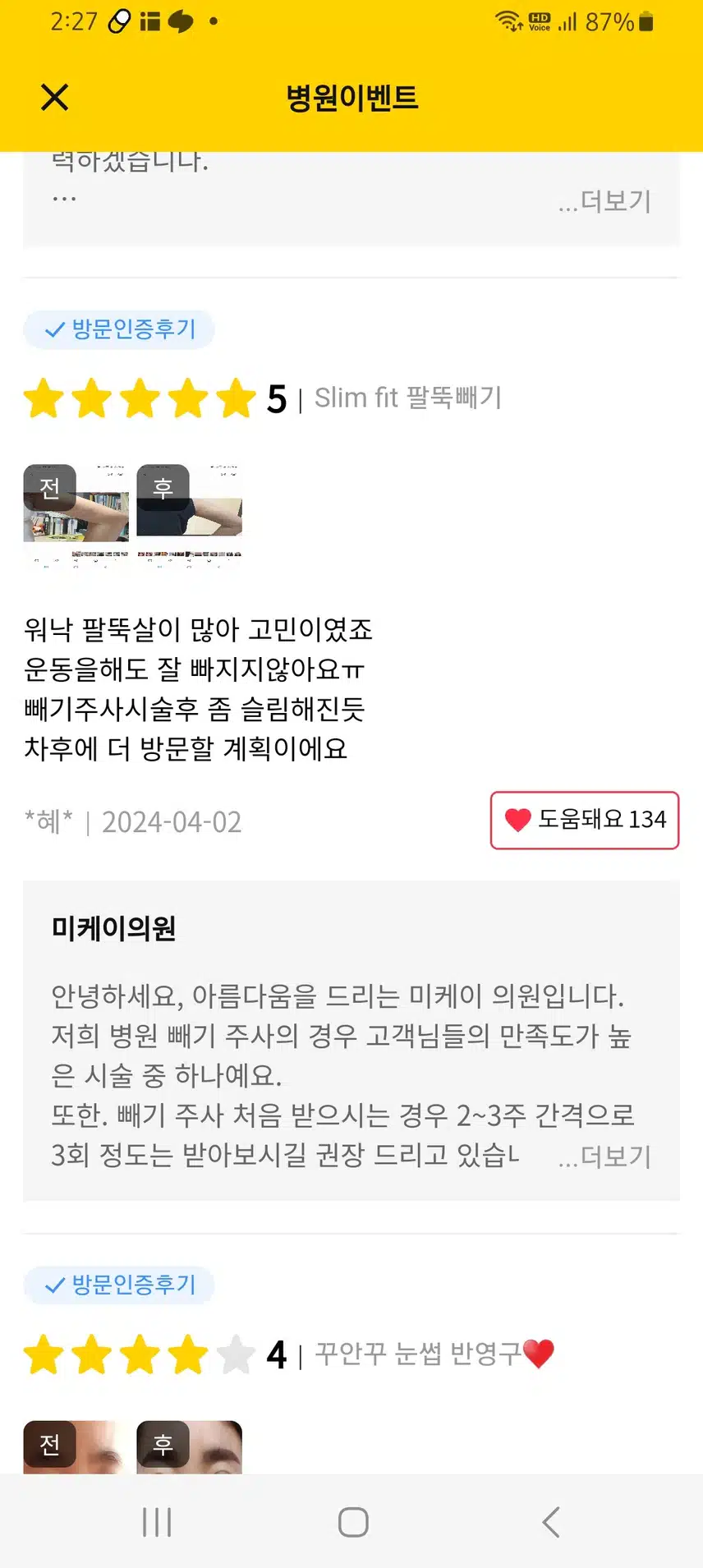 서초구 미케이의원 Slim fit 팔뚝빼기 9.5만원 후기