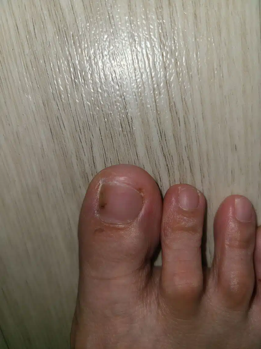 질문)발톱무좀으로 병원에 가야할까요?