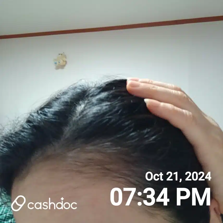 [고민]흰머리 카락을 너무 뽑으면 탈모가 올수 있나요?