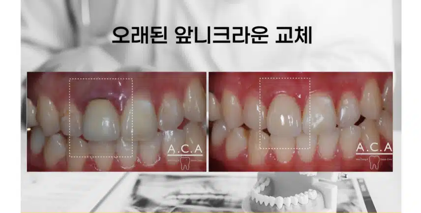앞니 크라운 잇몸쪽이 까맣게 보여요ㅜ