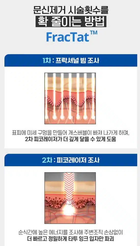 서울 컴포트성형외과 강남구 🐉편안한 문신제거🐉 후기 추천해요!!