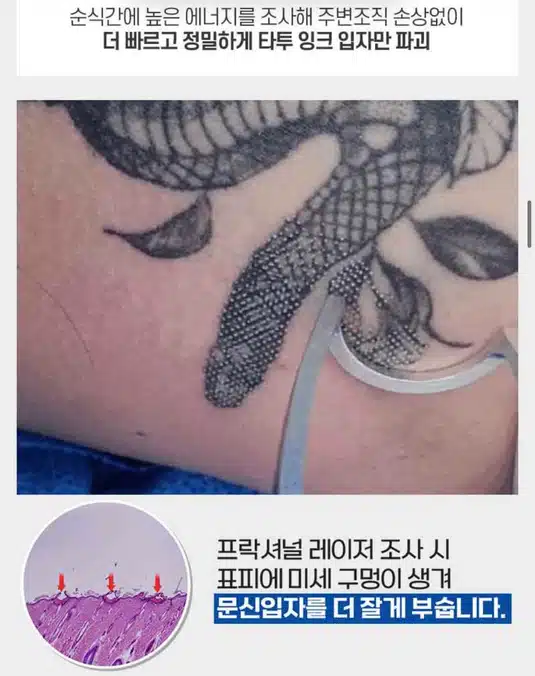 서울 컴포트성형외과 강남구 🐉편안한 문신제거🐉 후기 추천해요!!