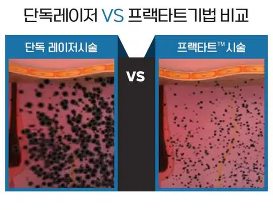 서울 컴포트성형외과 강남구 🐉편안한 문신제거🐉 후기 추천해요!!