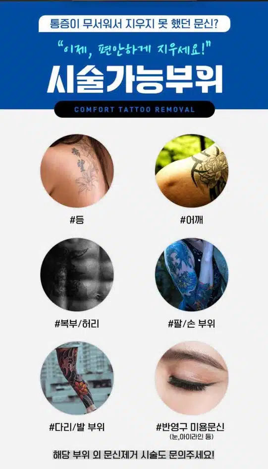 서울 컴포트성형외과 강남구 🐉편안한 문신제거🐉 후기 추천해요!!