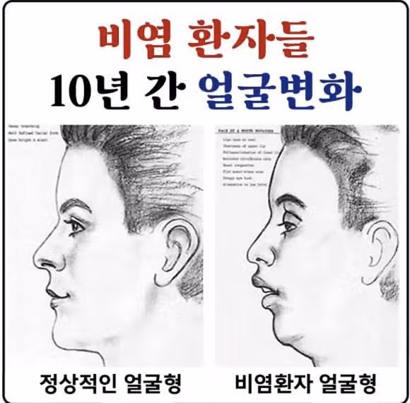 비염환자의 얼굴 변화
