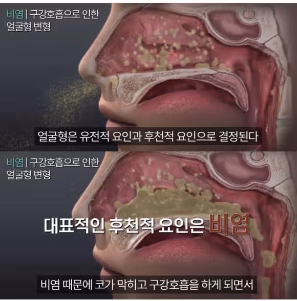 비염환자의 얼굴 변화