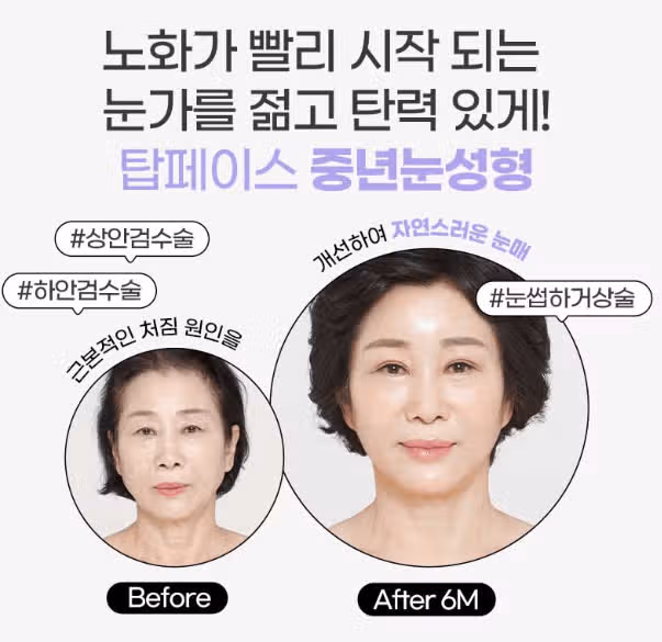 서울 강남구 탑페이스➰상안검#하안검성형➰ 후기 추천해요