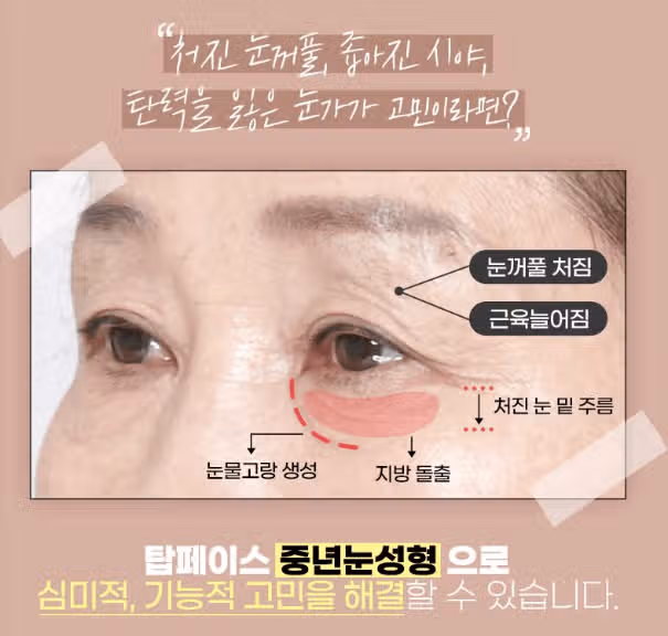 서울 강남구 탑페이스➰상안검#하안검성형➰ 후기 추천해요