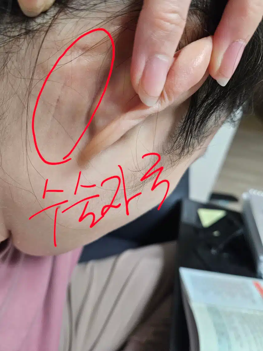중이염 수술후 부작용 때문에 고생중입니다.