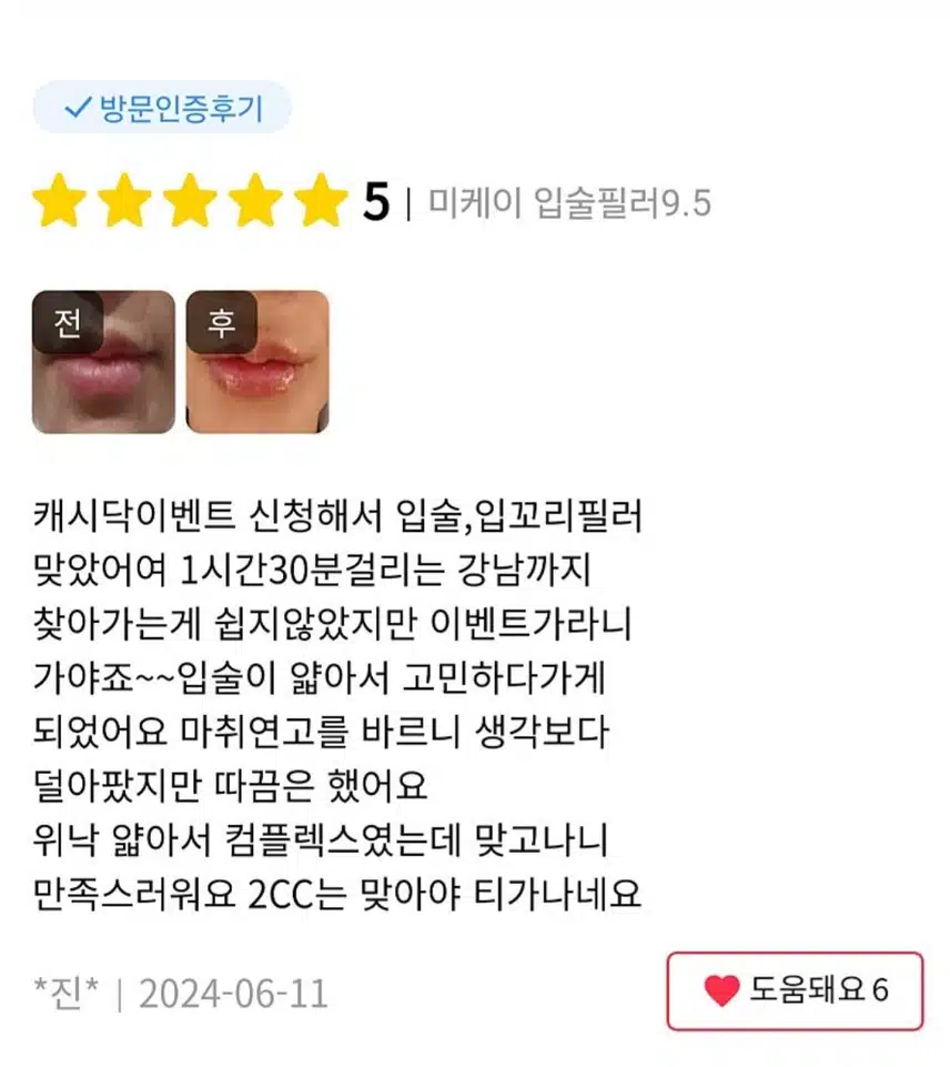 서초구 미케이의원 입술필러 9.5만원 후기