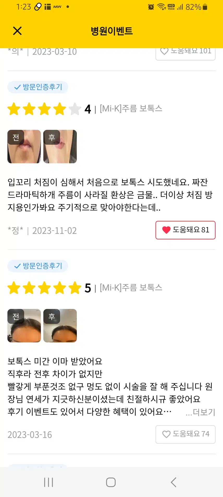서초구 미케이의원 주름보톡스 2.5만원 후기