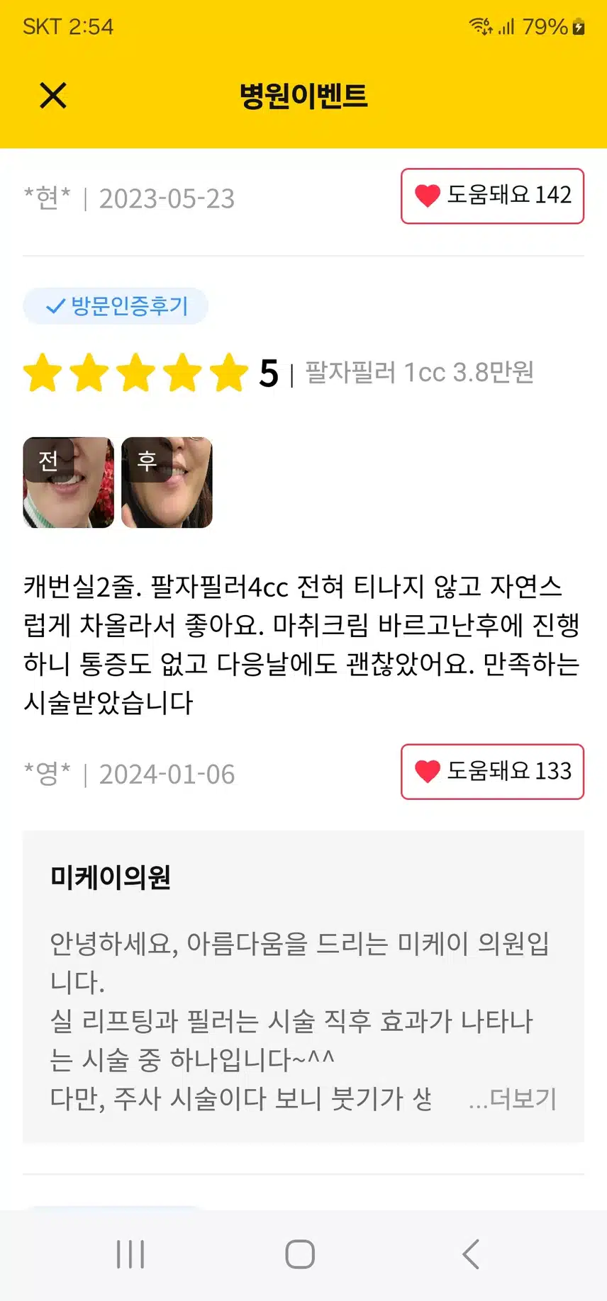 강남 서초 미케이의원 팔자필러 1cc 3.8만원 후기