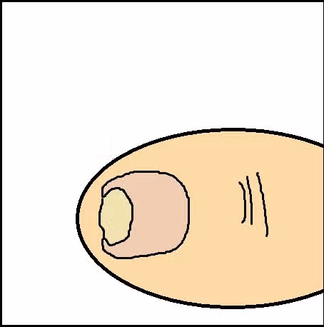 내성발톱때문에 고생하다가 병원에서 치료받은 후기