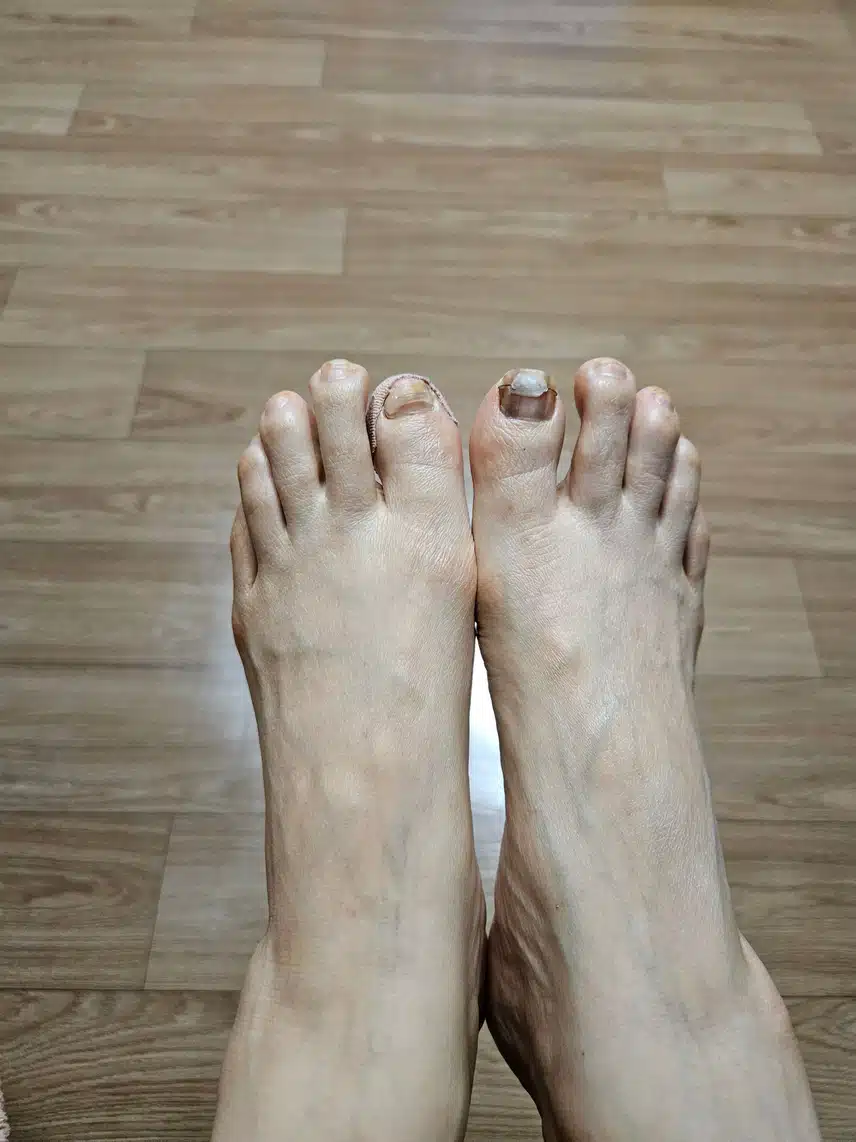 내성발톱때문에 고생하다가 병원에서 치료받은 후기